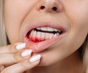 ulcerative-stomatitis-gums-gum-inflammation-woman-showing-red-bleeding-gingiva-with-ulcer ulcerative-stomatitis-gums-gum-inflammation-woman-showing-red-bleeding-gingiva-with-ulcer